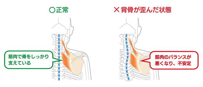 首・背中の痛み・寝違えは、放置せず早期治療が大切です